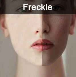 freckle