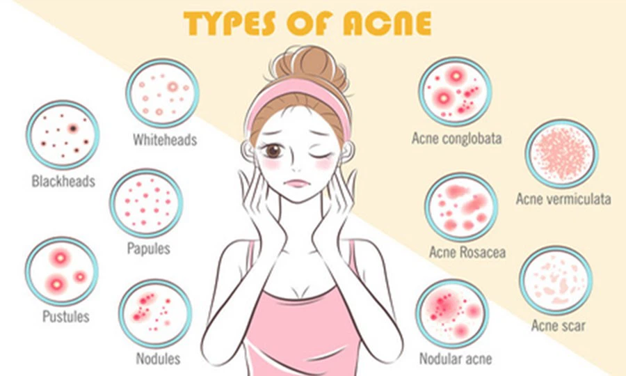 Treating acne Treating acne